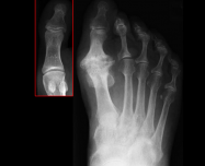 Comparison of Hallux Rigidus and normal toe